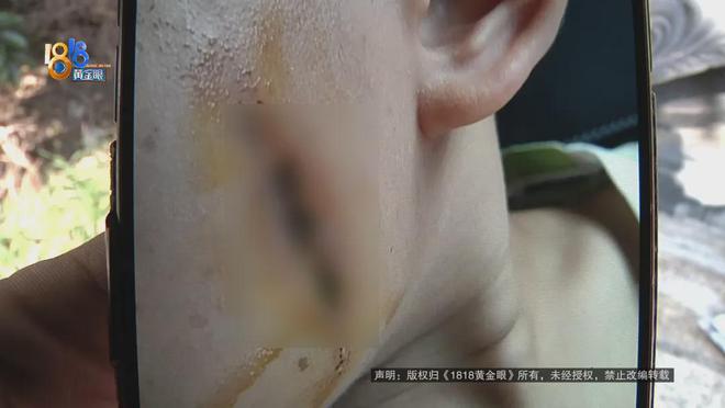 都断了……街头常见看见立即远离！m6米乐后怕！5岁男童瞬间晕厥筋(图5)
